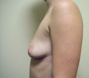 Breast Enlargement