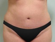 Tummy Tuck