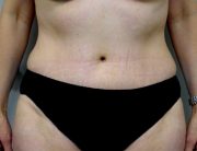 Tummy Tuck