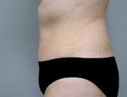 Tummy Tuck