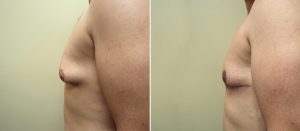 Tallahassee Plastic Surgery Clinic - Male Breast Reduction