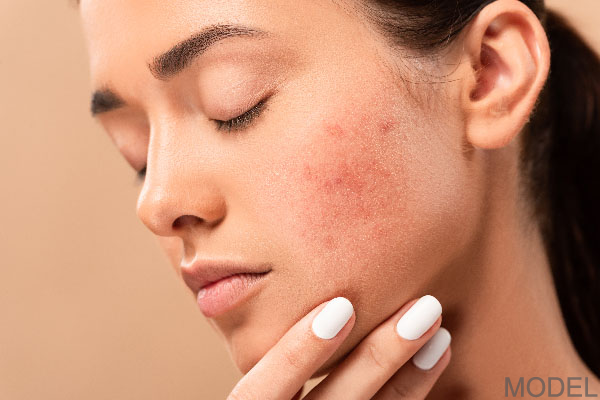 Young woman with closed eyes touching face with acne