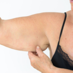 Woman pinching upper arm skin